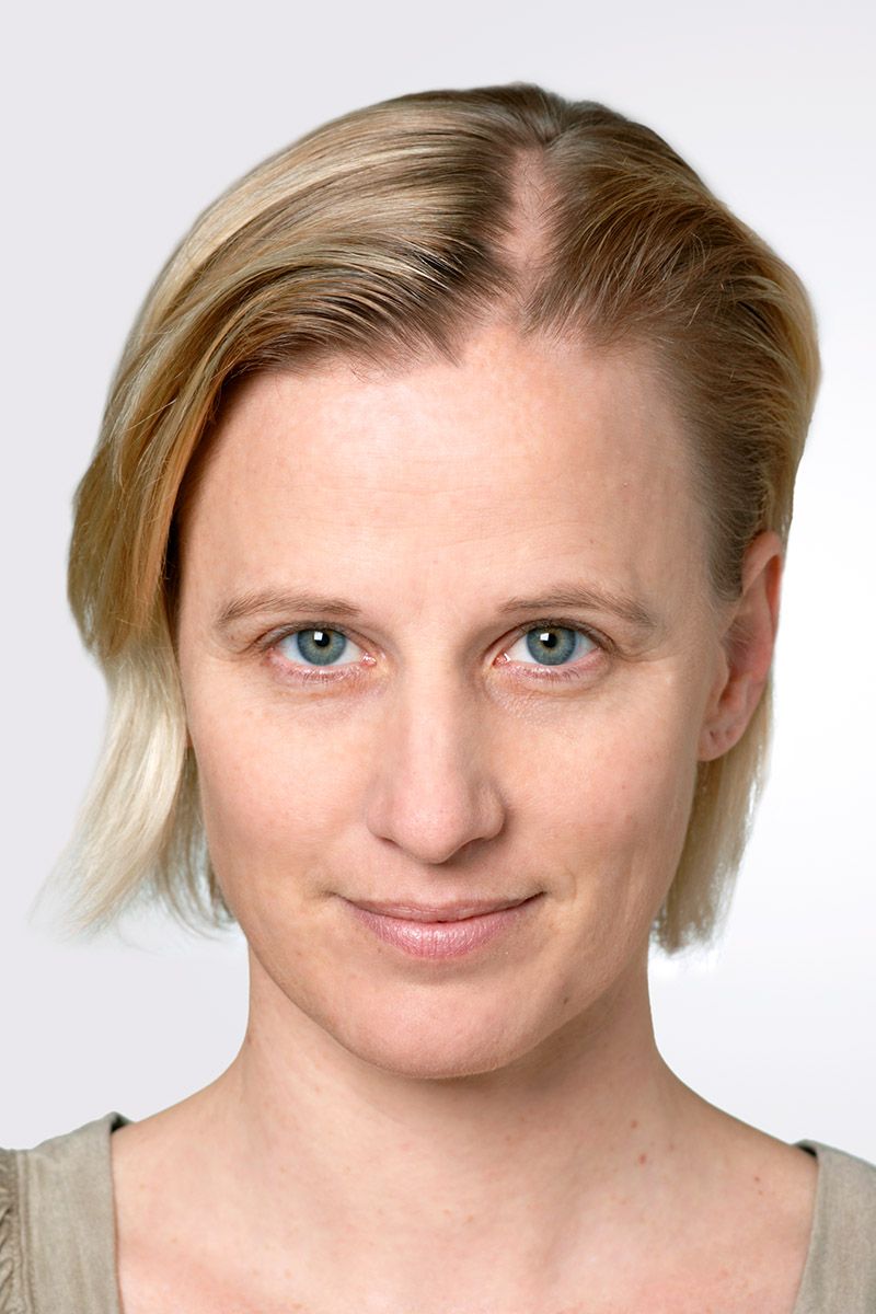 Vorher: schütteres Haar am Scheitel